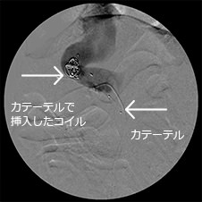 肝内門脈シャントに対するカテーテル 治療