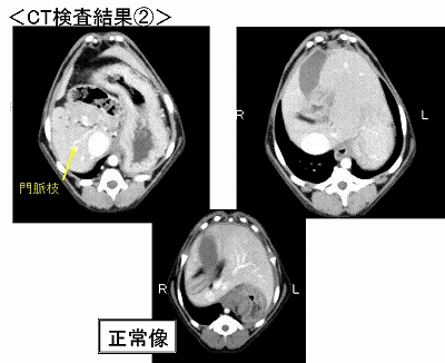 p15 門脈シャント図3