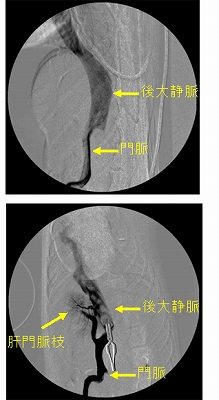 p15 門脈シャント図8