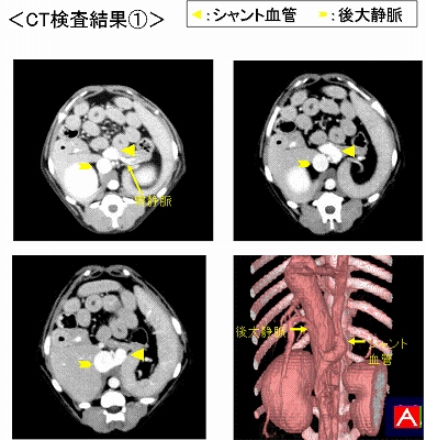 p15 門脈シャント図2